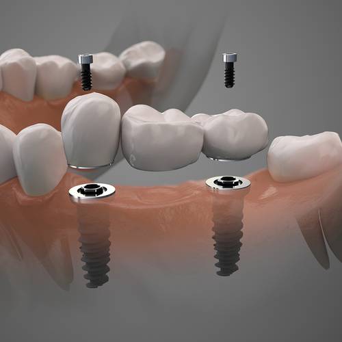 Family Dentist Fox Family Dental Sun City AZ Dental Implants Services Image