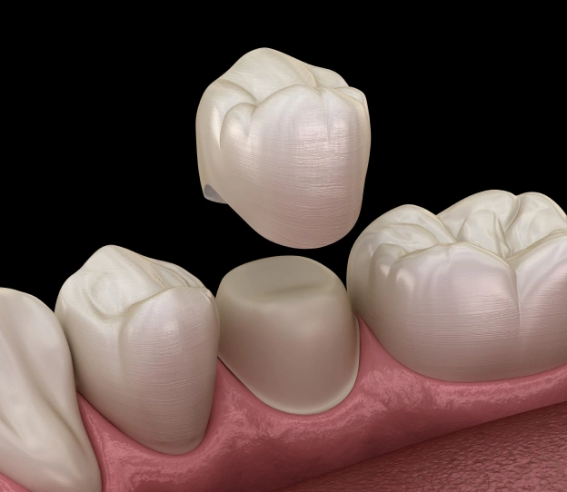 dental-crowns