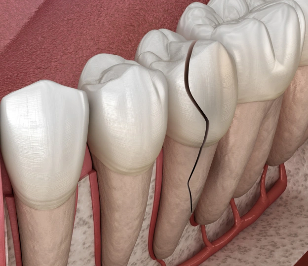 treatment-of-cracked