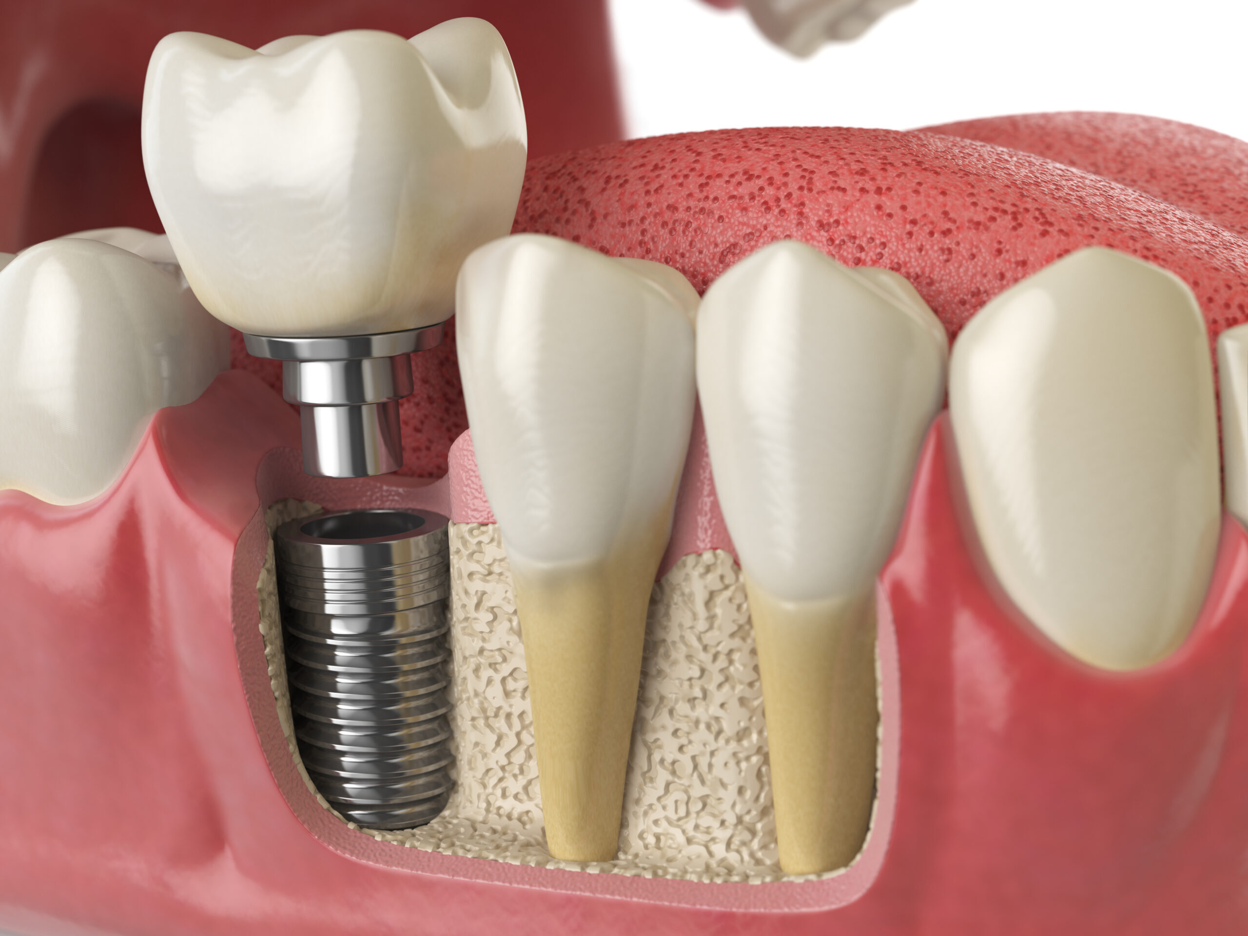 Dental implant cross-section showing titanium screw anchored in jawbone with ceramic crown restoration.